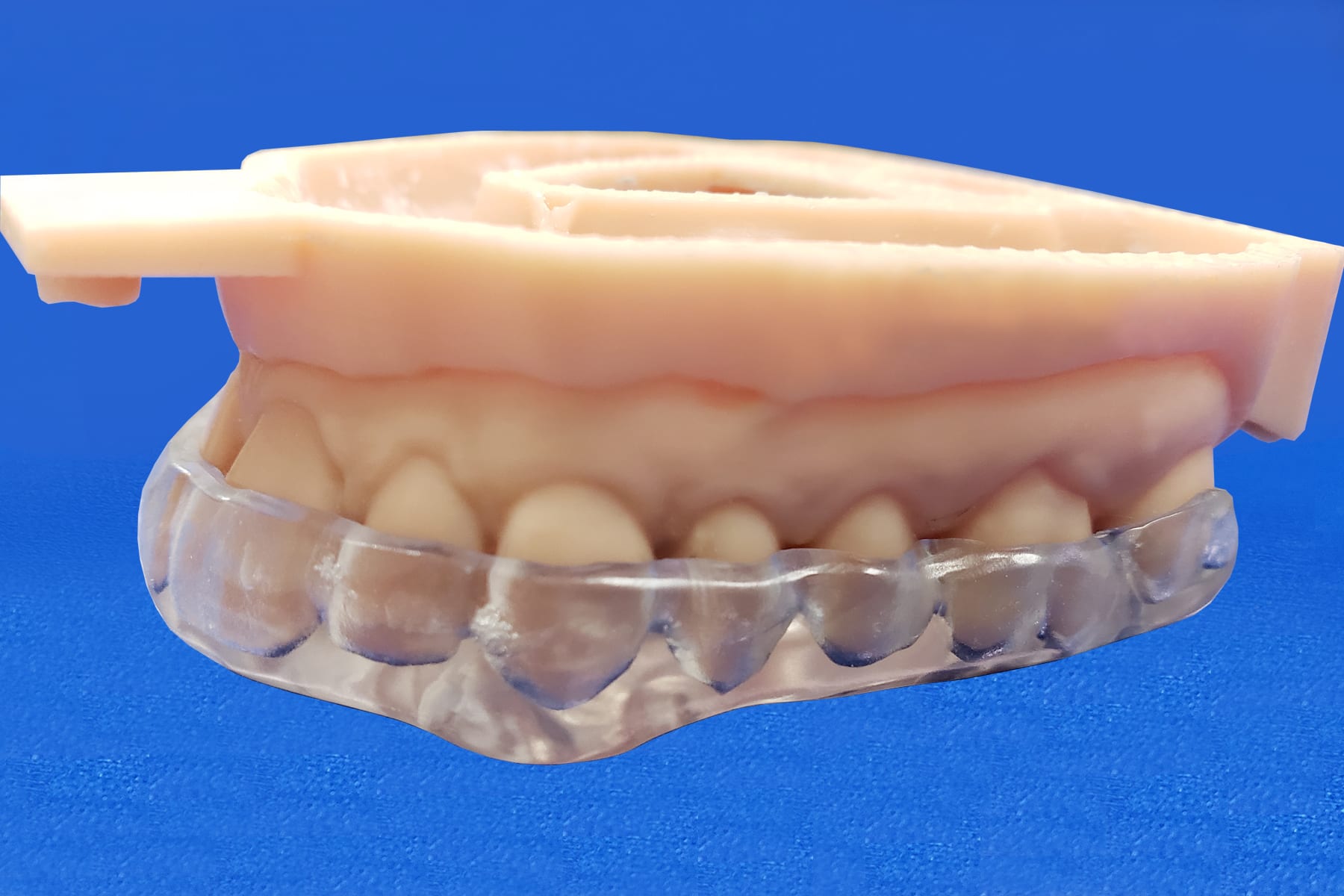 Splints - Excel Orthodontics